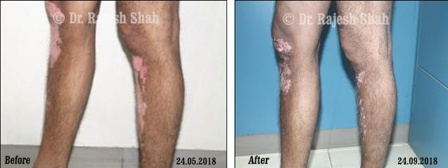 Vitiligo Before and After Case Photo