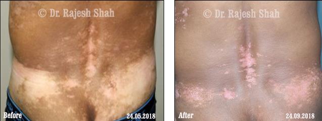 Vitiligo Before and After Case Photo