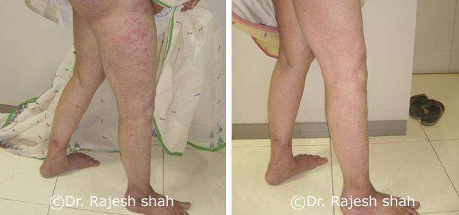 Psoriasis Before and After Case Photo