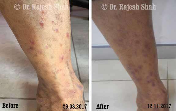 Lichen Planus Before and After Case Photo