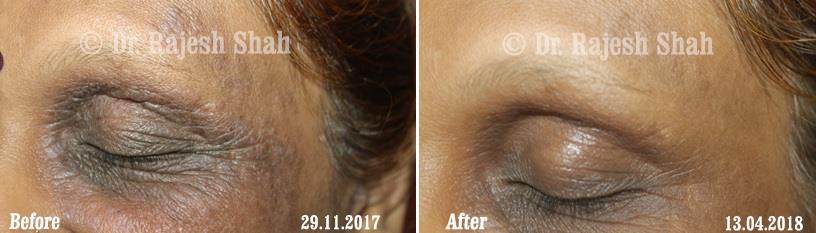 Eczema Before and After Case Photo