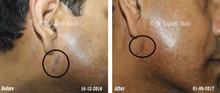 Lichen Planus Before and After Case Photo