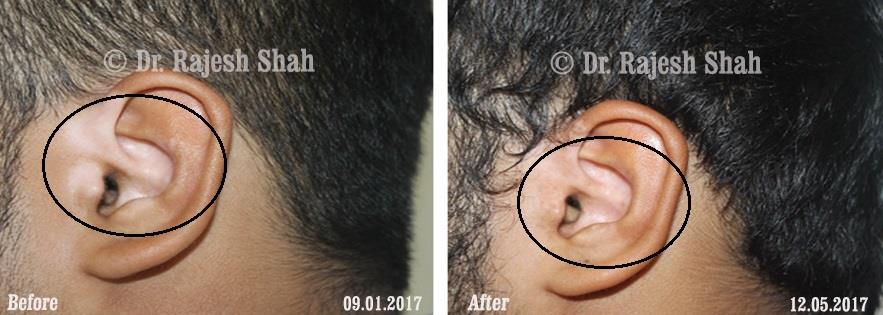 Vitiligo Before and After Case Photo