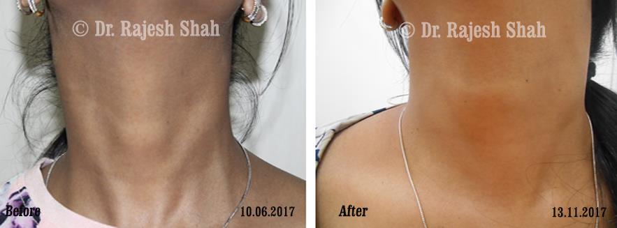 Lichen Planus Pigmentosa Before and After Case Photo