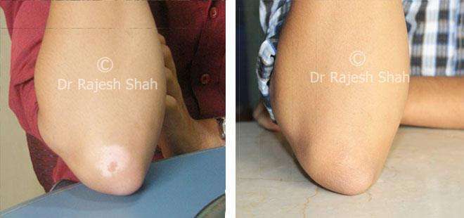 Vitiligo Before and After Case Photo