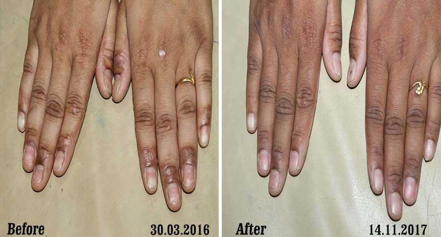 Psoriasis Before and After Case Photo