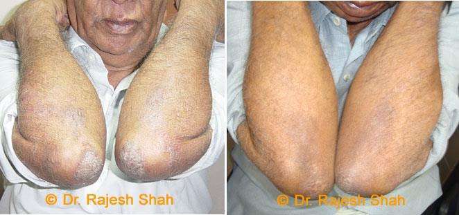 Psoriasis Before and After Case Photo