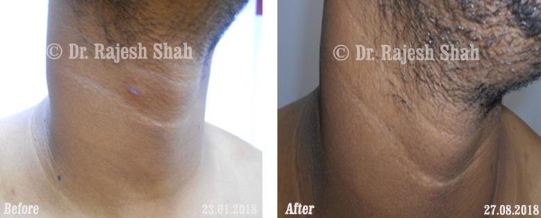 Psoriasis Before and After Case Photo