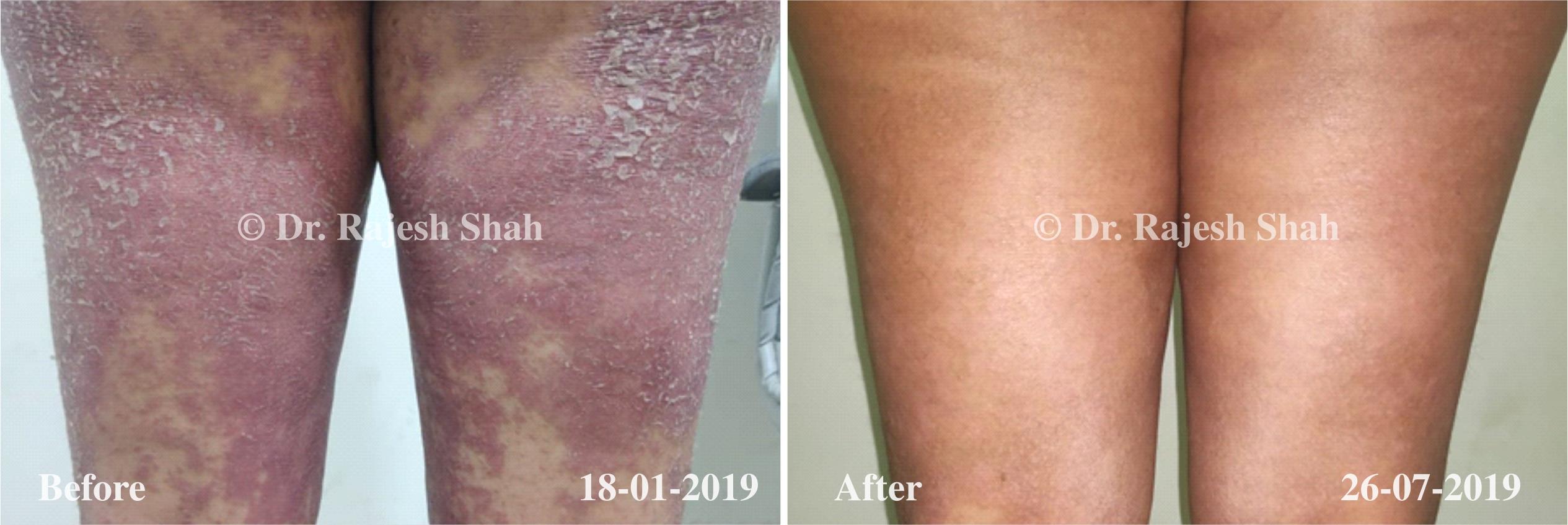 Psoriasis Before and After Case Photo