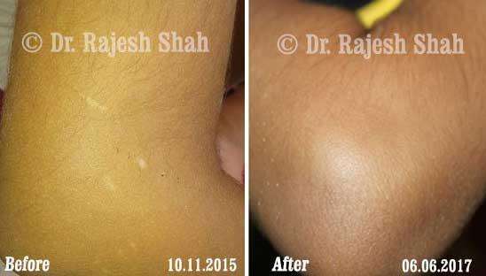 Vitiligo Before and After Case Photo