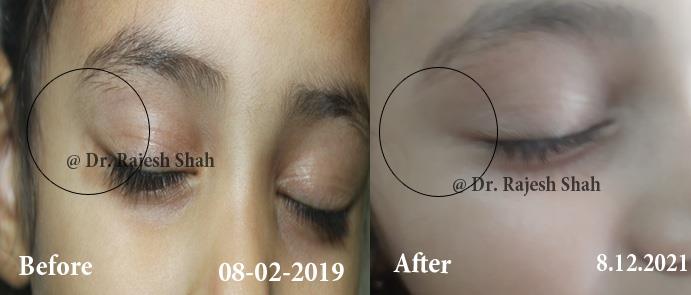 Vitiligo Before and After Case Photo