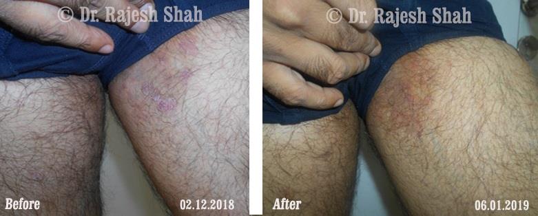 Psoriasis Before and After Case Photo