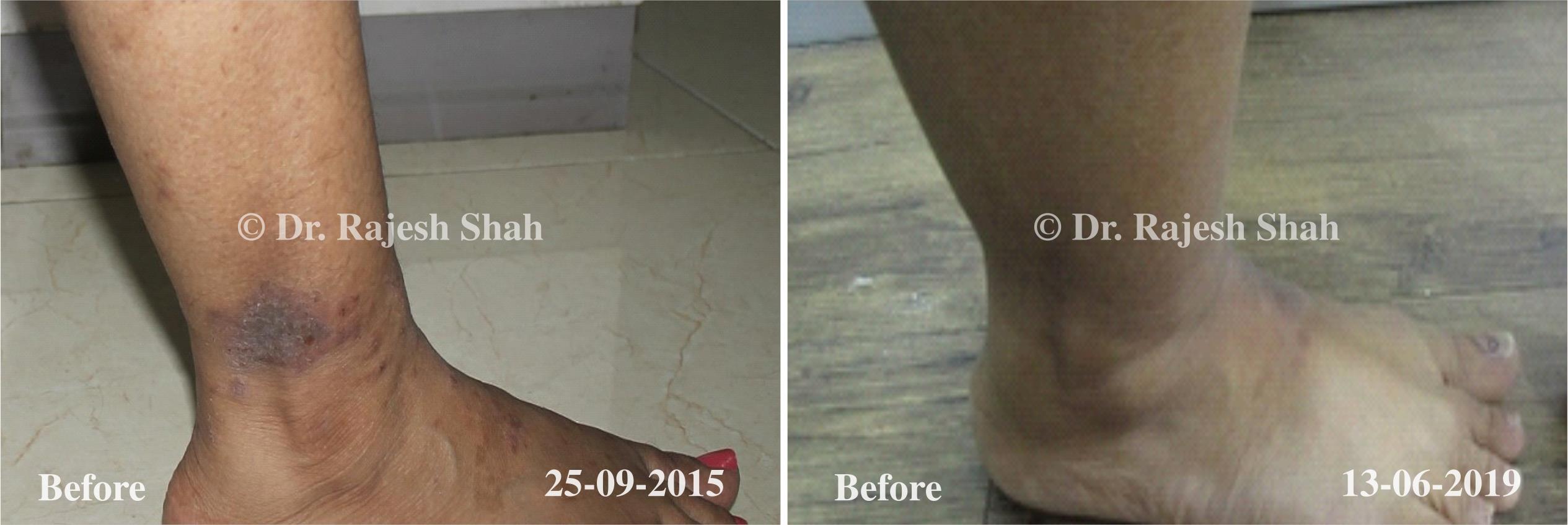 Psoriasis Before and After Case Photo