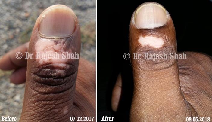 Vitiligo Before and After Case Photo
