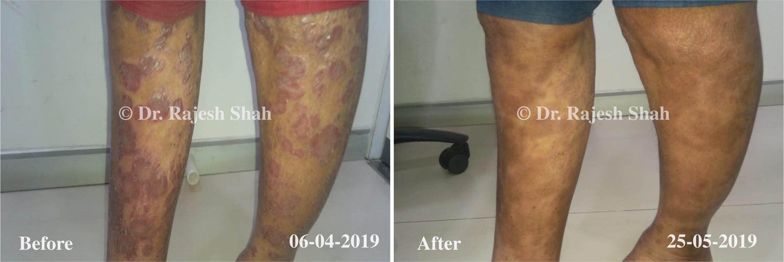 Psoriasis Before and After Case Photo
