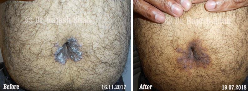 Psoriasis Before and After Case Photo