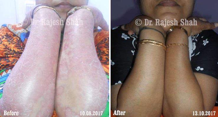 Psoriasis Before and After Case Photo