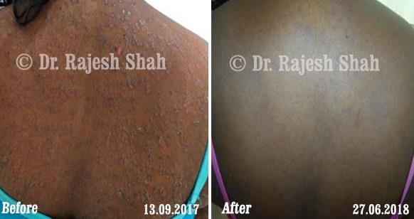 Psoriasis Before and After Case Photo