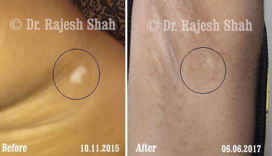 Vitiligo Before and After Case Photo
