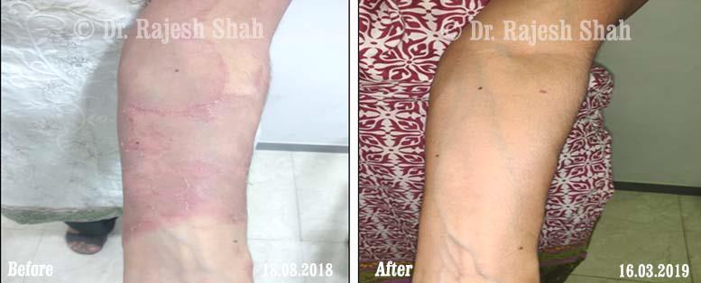 Psoriasis Before and After Case Photo