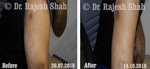 Psoriasis Before and After Case Photo