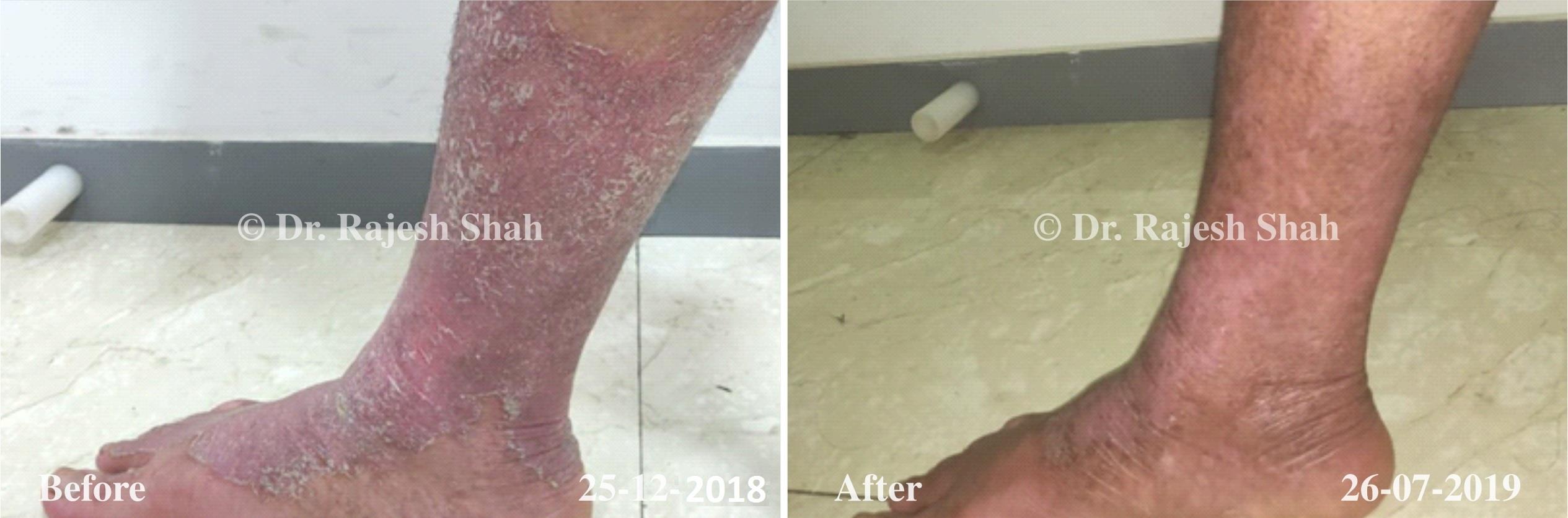 Psoriasis Before and After Case Photo