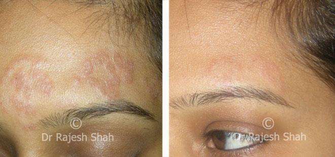 Lichen Planus Before and After Case Photo