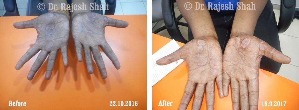 Psoriasis Before and After Case Photo