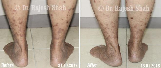 Lichen Planus Before and After Case Photo