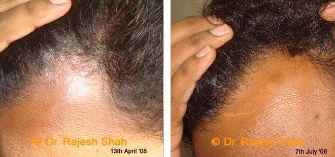 Psoriasis Before and After Case Photo