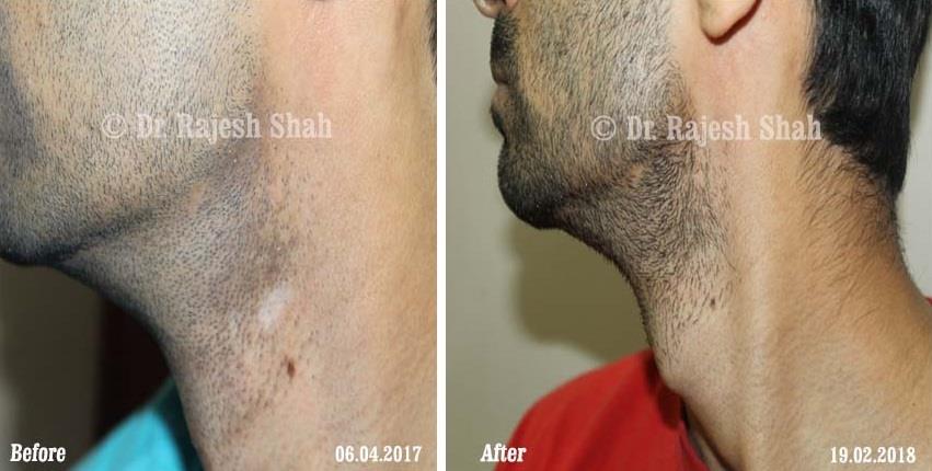 Vitiligo Before and After Case Photo