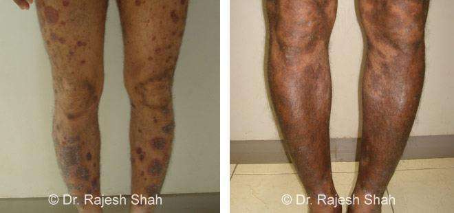 Psoriasis Before and After Case Photo