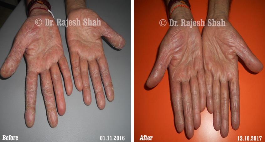 Psoriasis Before and After Case Photo