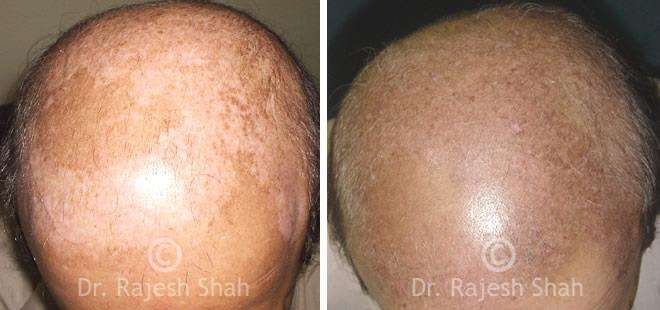 Vitiligo Before and After Case Photo