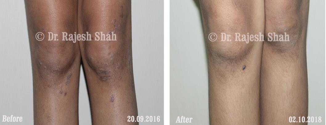 Lichen Planus Before and After Case Photo