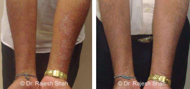 Psoriasis Before and After Case Photo