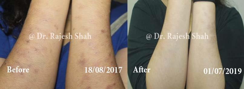 Lichen Planus Before and After Case Photo