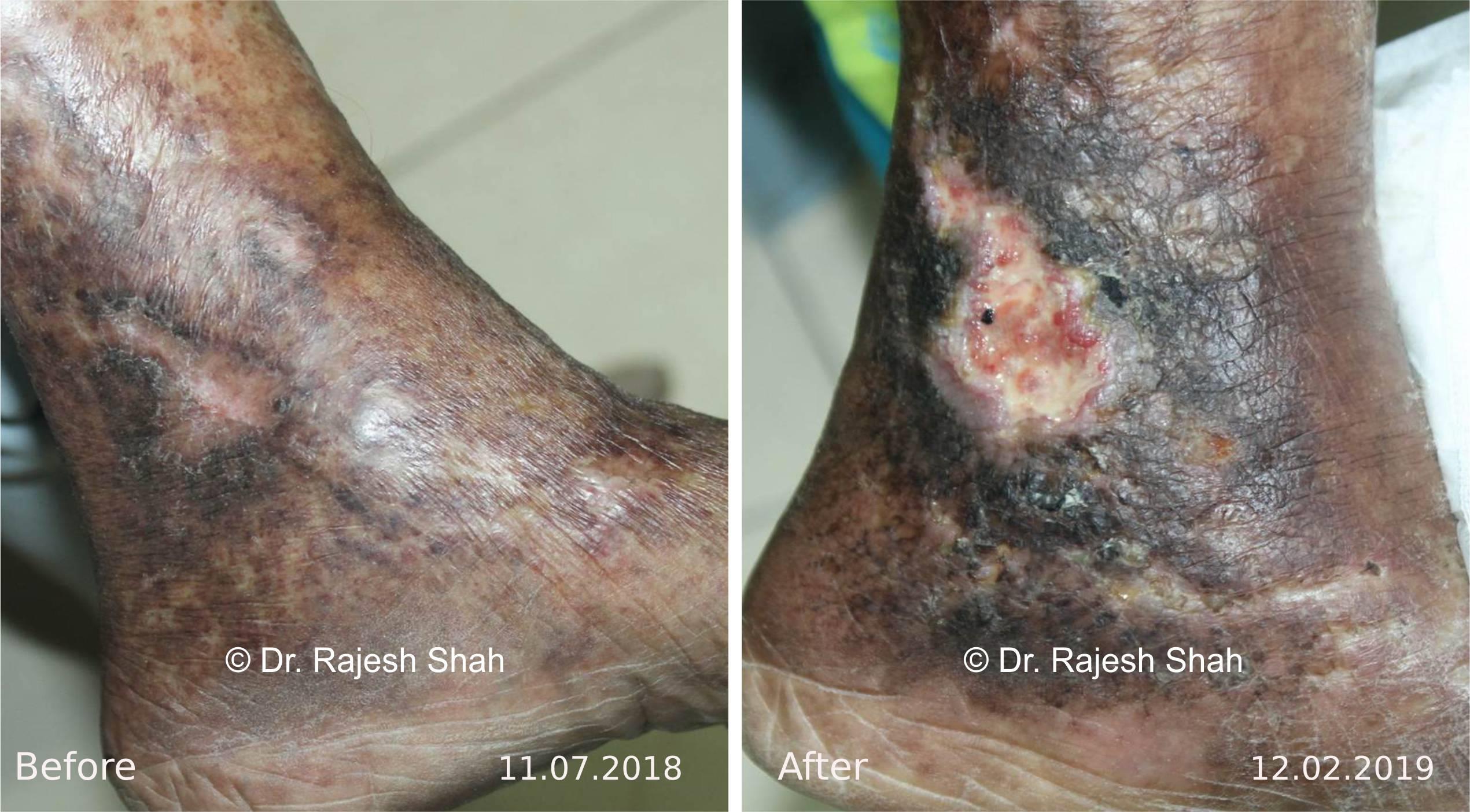 Non-healing ulcers Before and After Case Photo
