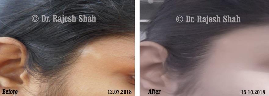 Acne Before and After Case Photo