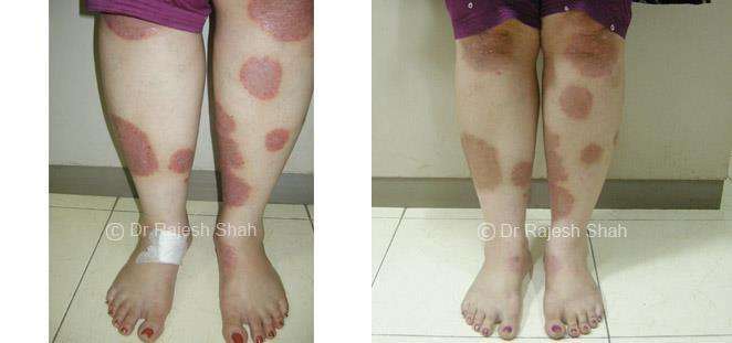 Psoriasis Before and After Case Photo