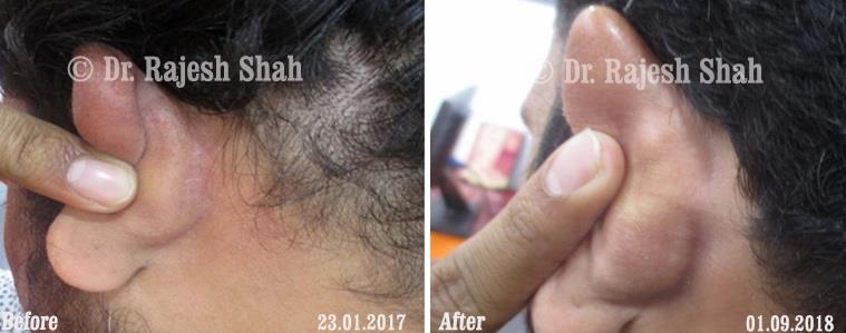 Psoriasis Before and After Case Photo