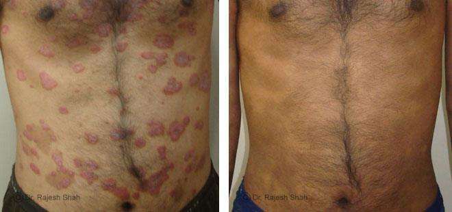 Psoriasis Before and After Case Photo