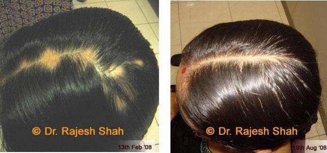 Alopecia Areata Before and After Case Photo