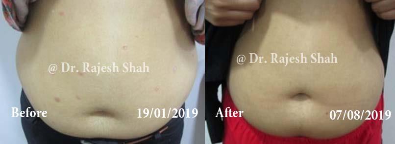 Psoriasis Before and After Case Photo