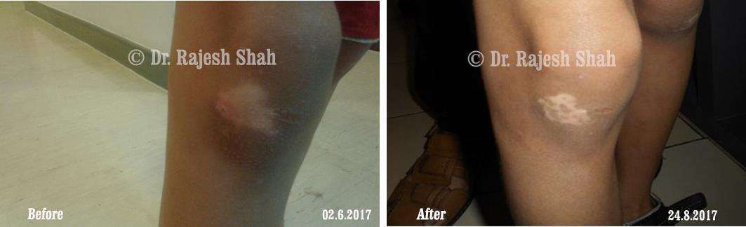Vitiligo Before and After Case Photo