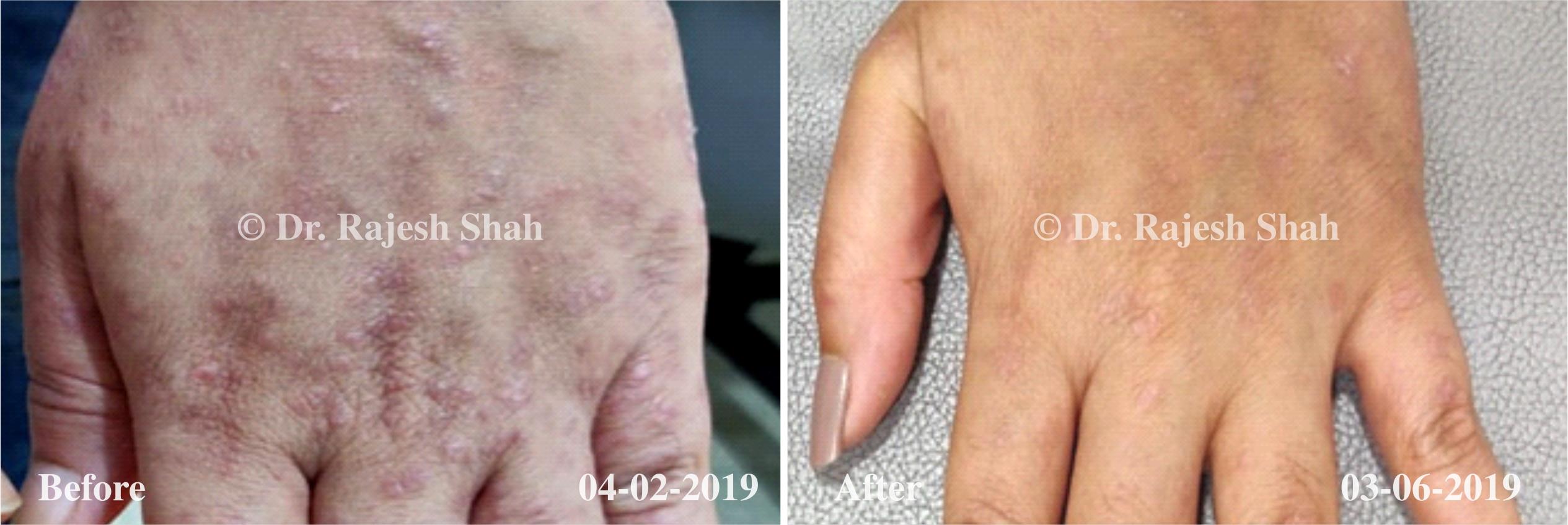 Psoriasis Before and After Case Photo