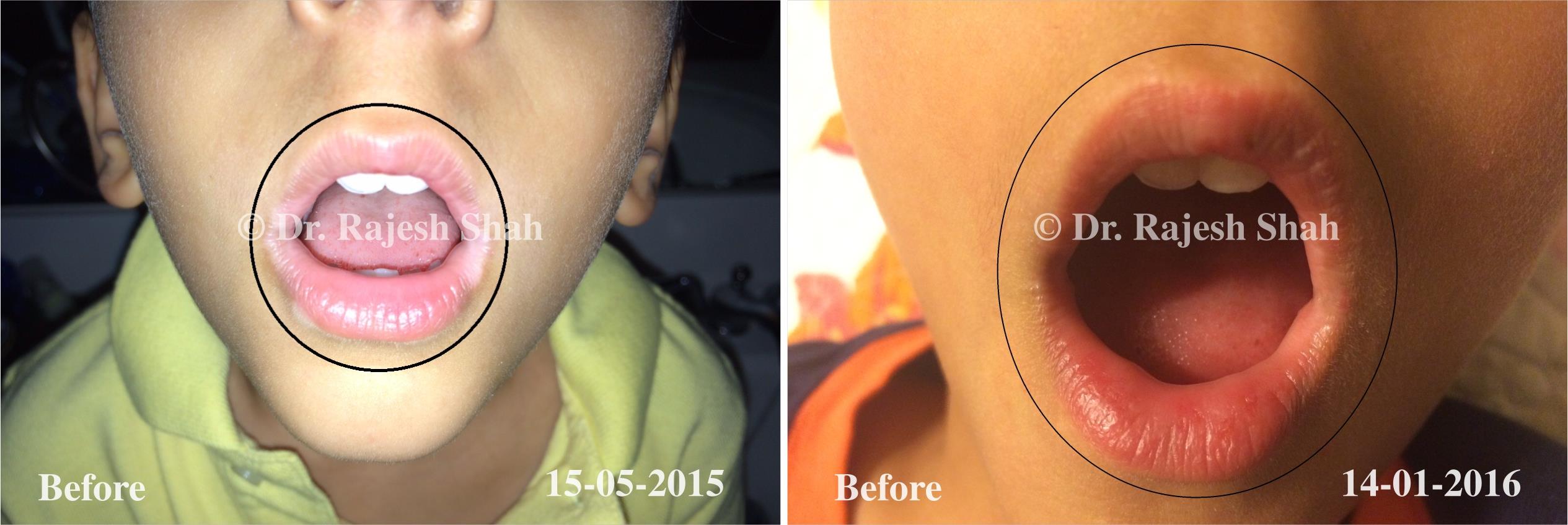 Vitiligo Before and After Case Photo