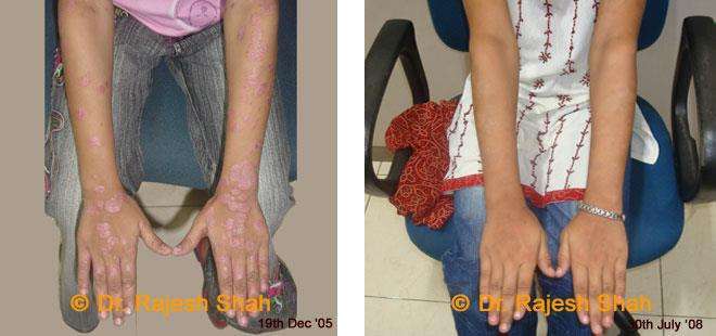 Psoriasis Before and After Case Photo