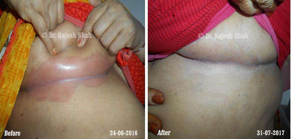 Psoriasis Before and After Case Photo