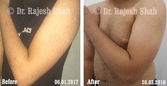 Lichen Planus Before and After Case Photo